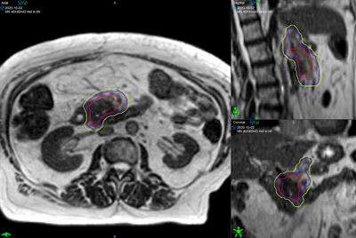 Induction Chemotherapy and Ablative Stereotactic Magnetic Resonance Image-Guided Adaptive Radiation Therapy for Inoperable Pancreas Cancer